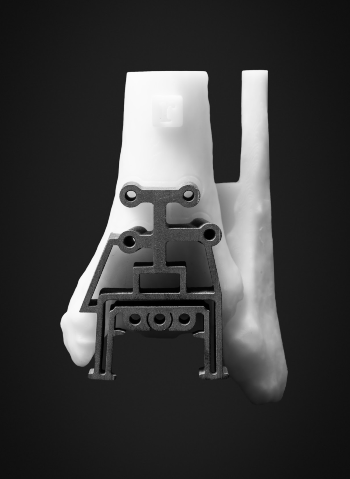 restor3D ankle implant